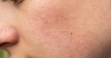 Mụn ẩn dưới da: “Kẻ thù vô hình” của làn da và 3 bước xử lý hiệu quả