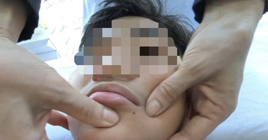 Miền Bắc rét sâu, gia tăng số người bị méo miệng: Chuyên gia chỉ cách bảo vệ sức khỏe 