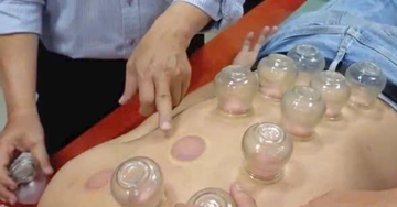 Đột quỵ nặng khi nhờ chị gái giác hơi