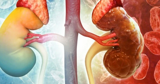 Thanh niên 30 tuổi đang khỏe mạnh sững sờ phát hiện suy thận: 'Tôi không hề đau, không mệt, sinh hoạt bình thường'