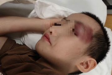 Thông tin mới vụ bé trai 6 tuổi bị chấn thương sọ não khi gửi tại cơ sở can thiệp