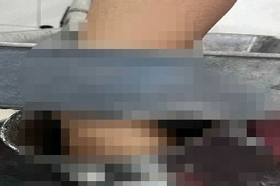Dùng tay đưa thịt vào máy xay, nữ nhân viên gặp tai nạn nghiêm trọng