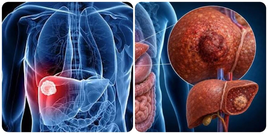 9 triệu chứng ung thư gan giai đoạn đầu