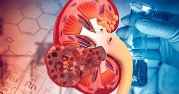 8 thói quen gây suy thận, người Việt cần biết để tránh