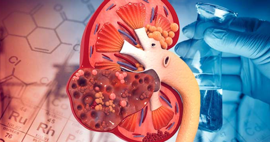8 thói quen gây suy thận, người Việt cần biết để tránh