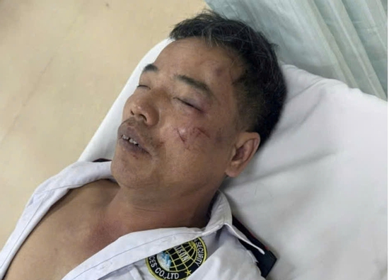 Truy tìm nhóm thanh niên nẹt pô, đánh bảo vệ gãy xương sườn