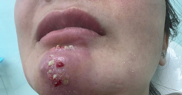 Tin quảng cáo “bật tông nhanh”, nhiều người biến dạng mặt vì làm đẹp cận Tết