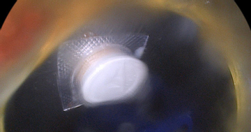 Uống thuốc giảm đau vai gáy, người đàn ông nhập viện gấp vì một sai sót nhiều người Việt mắc phải