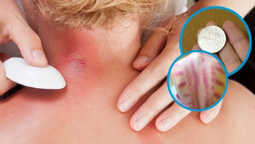Vì sao đau mỏi người, 'trúng gió' dùng đồ bạc, trứng gà để cạo gió?