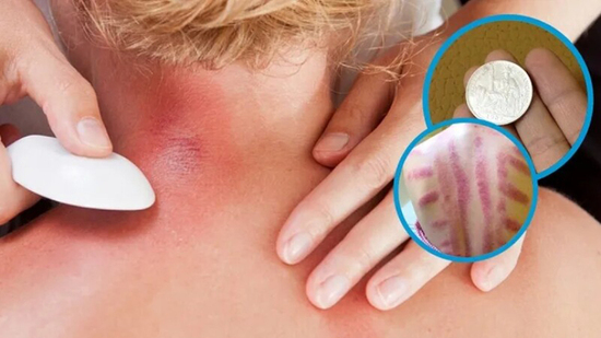 Vì sao đau mỏi người, 'trúng gió' dùng đồ bạc, trứng gà để cạo gió?