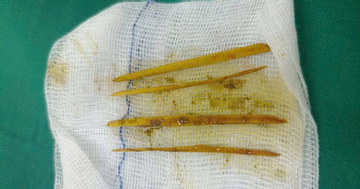 Nuốt tăm khi ăn cỗ cưới, cô gái 26 tuổi nhập viện gấp vì suýt thủng đại tràng