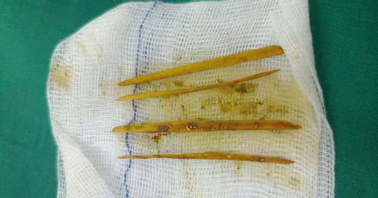 Nuốt tăm khi ăn cỗ cưới, cô gái 26 tuổi nhập viện gấp vì suýt thủng đại tràng