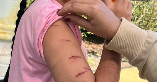 Nữ sinh lớp 5 ở Cà Mau bị người thân dùng dao cắt giấy gây thương tích