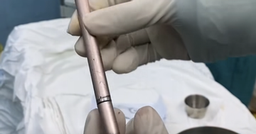 Thiếu nữ dùng cây bút gãi ngứa vùng kín rồi bị mắc kẹt trong bàng quang