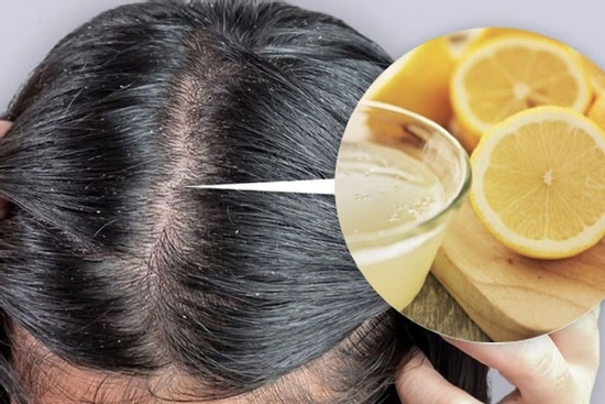 Trị gàu bằng chanh: Có thật sự hiệu quả như nhiều người vẫn làm?