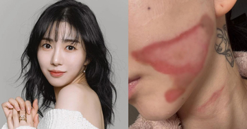 Gương mặt nữ ca sĩ 33 tuổi bị bỏng nghiêm trọng sau thẩm mỹ