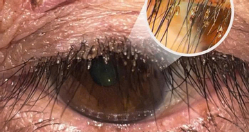 Bác sĩ bất ngờ về ổ rận mu bám chi chít trên lông mi người phụ nữ