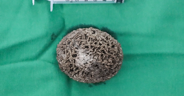 Người đàn ông 50 tuổi đau hạ vị kéo dài, bác sĩ sốc khi gắp ra thứ 