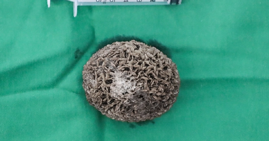 Người đàn ông 50 tuổi đau hạ vị kéo dài, bác sĩ sốc khi gắp ra thứ 