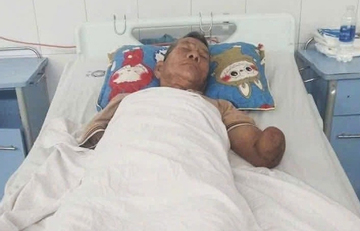 Tình trạng sức khỏe cụ ông sau khi kẹp con rắn hổ mang cắn mình về nhà