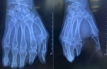 8 giờ vi phẫu nghẹt thở nối lại 4 ngón tay đứt lìa cho người đàn ông