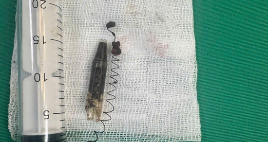 Thanh niên 29 tuổi bị đầu bút, lò xo găm trong thái dương suốt 13 năm