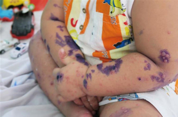 Gần 3.000 trẻ mắc chân tay miệng trong 2 tháng, 3 dấu hiệu cần đưa con đi viện