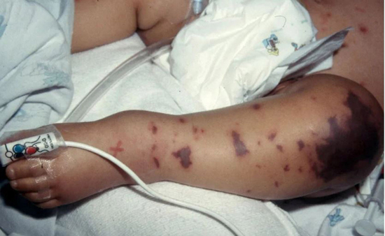 Liên tiếp ghi nhận ca mắc não mô cầu, nhận diện sớm dấu hiệu điển hình