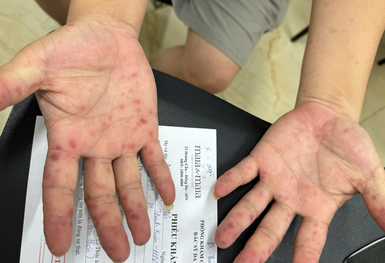 Số ca tay chân miệng tăng mạnh, cảnh báo nguồn lây từ tay nắm cửa, đồ chơi