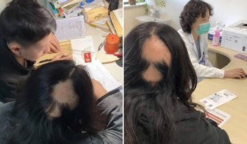 Người mẹ rụng tóc cả mảng lớn do áp lực con 'học dốt', phải kèm con học khuya