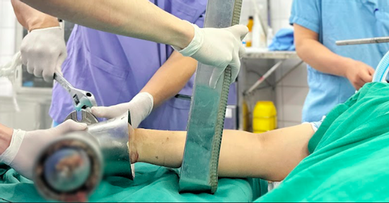 Bàn tay mắc kẹt trong máy xay thịt, người phụ nữ trẻ phải cắt cụt chi