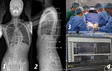 Cô gái soi gương thấy lưng có dấu hiệu lạ, không ngờ cột sống đã cong 53 độ