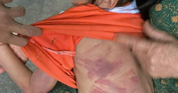 Bé gái lớp 2 bị bạn dùng thước đánh bầm tím người