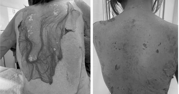 Người phụ nữ Hải Phòng bị tróc da như 'cua lột', lý do tự mua thuốc dị ứng