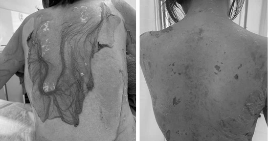 Người phụ nữ Hải Phòng bị tróc da như 'cua lột', lý do tự mua thuốc dị ứng