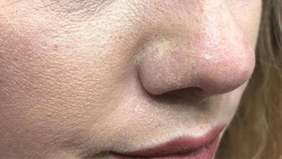 Vì sao thoa kem chống nắng bị mốc trắng, xử lý thế nào?