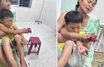 Cháu bé bị dập bàn tay nghi do điện thoại nổ lúc sạc pin