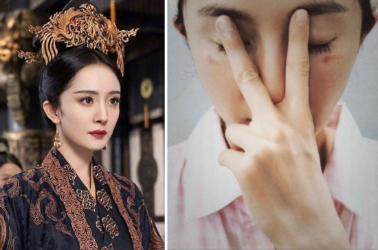 Dương Mịch bị bỏng mặt vì sử dụng mặt nạ hơi nước