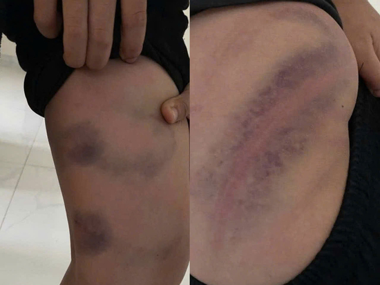 Bé trai ở Bắc Ninh bị cha đánh bầm tím vì lười học