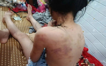 Hé lộ nguyên nhân vụ nữ sinh lớp 4 ở Cao Bằng bị nhóm bạn hành hung, cơ thể nhiều vết thâm tím