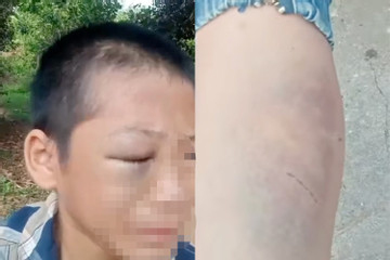 Xác minh clip bé trai mắt bầm tím, khóc kêu cứu vì 'nhiều lần bị đánh đập'