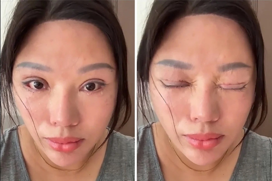 Phẫu thuật mí mắt hỏng, nạn nhân còn bị kiện ngược