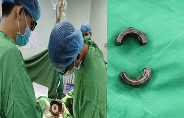 Bác sĩ tại Cần Thơ dùng máy cắt cứu người đàn ông ở An Giang gặp nạn vì “nâng cấp dương vật