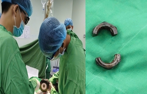 Bác sĩ tại Cần Thơ dùng máy cắt cứu người đàn ông ở An Giang gặp nạn vì “nâng cấp dương vật