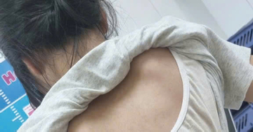 Cột sống thiếu nữ 'uốn lượn' hình chữ S, bác sĩ chỉ ra sai lầm nhiều người mắc