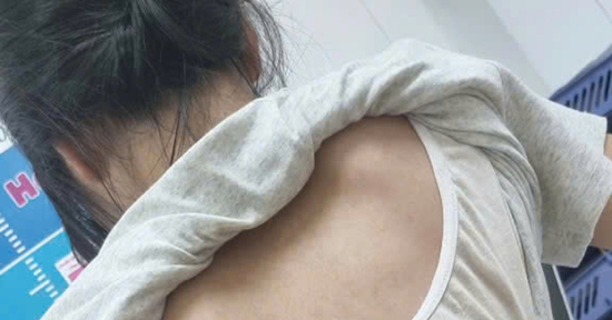 Cột sống thiếu nữ 'uốn lượn' hình chữ S, bác sĩ chỉ ra sai lầm nhiều người mắc