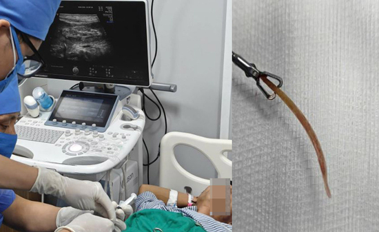 Đau bụng suốt 10 ngày, bất ngờ phát hiện tăm tre đâm thủng đại tràng
