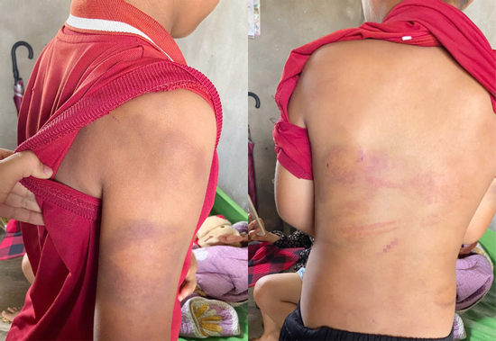 Vụ phát hiện trên người cháu ngoại chi chít vết bầm tím: Nhói lòng trước lời kể của bé trai 10 tuổi