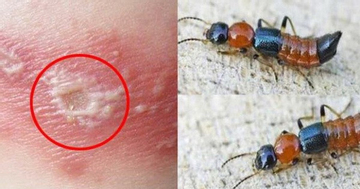 Những sai lầm phổ biến khi nhầm viêm da do kiến ba khoang với bệnh zona thần kinh