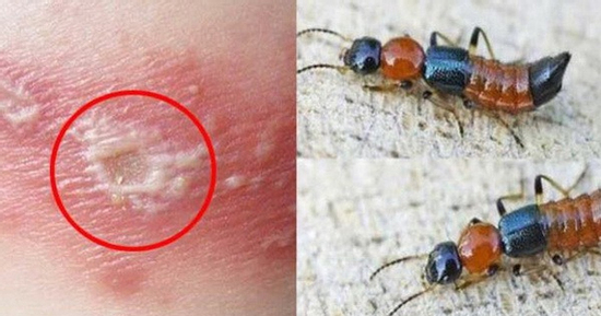 Những sai lầm phổ biến khi nhầm viêm da do kiến ba khoang với bệnh zona thần kinh